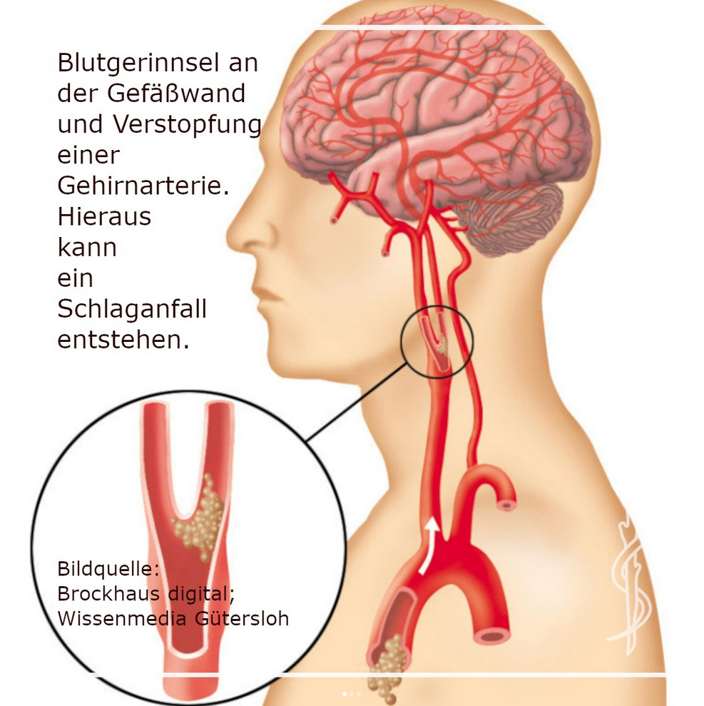 Schlaganfall - Bild: Brockhaus digital, Wissenmedia Gütersloh